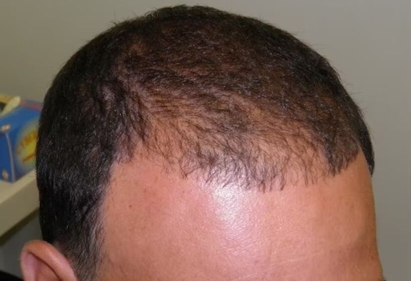 Hair loss before using Verdoxidil
