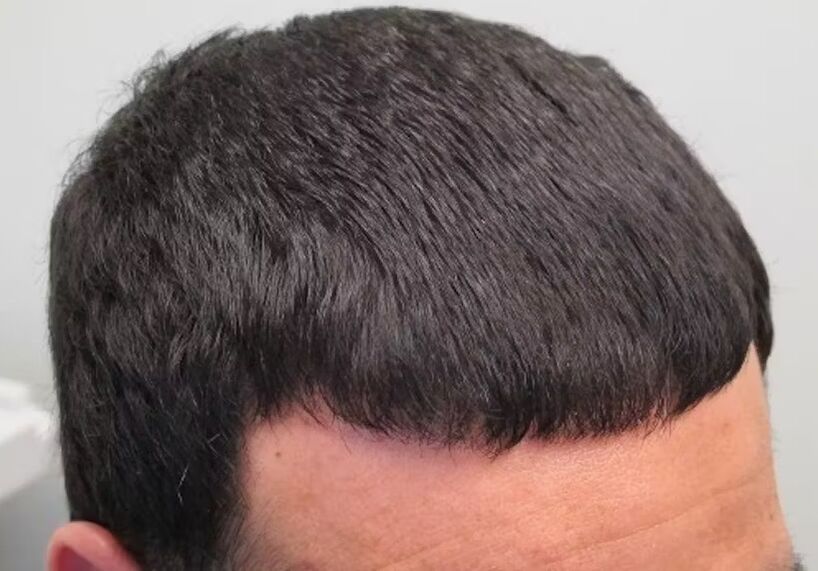 I edited Verdoxidil for hair loss