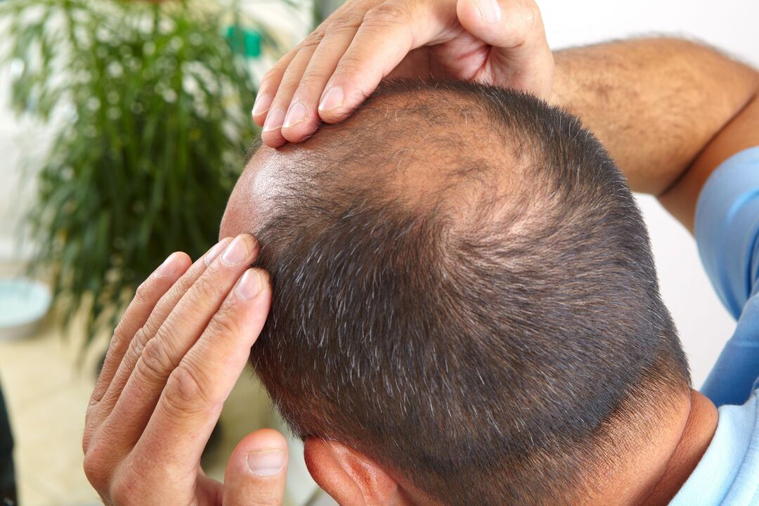 Perform the ZXCVBNQWORT spray for the treatment of baldness